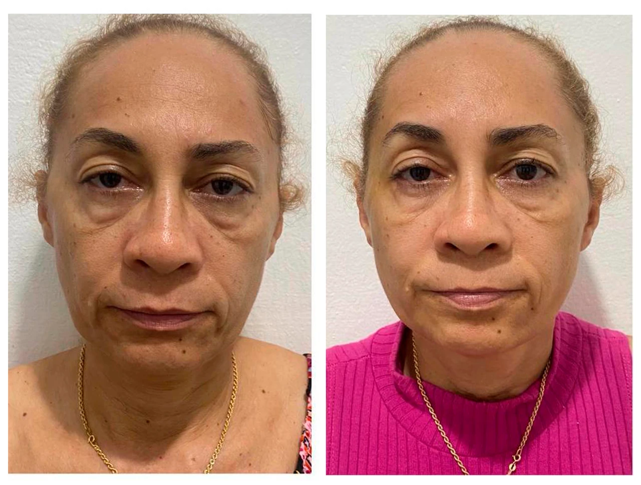 Resultado de harmonização facial — Dra. Tulipa Braga