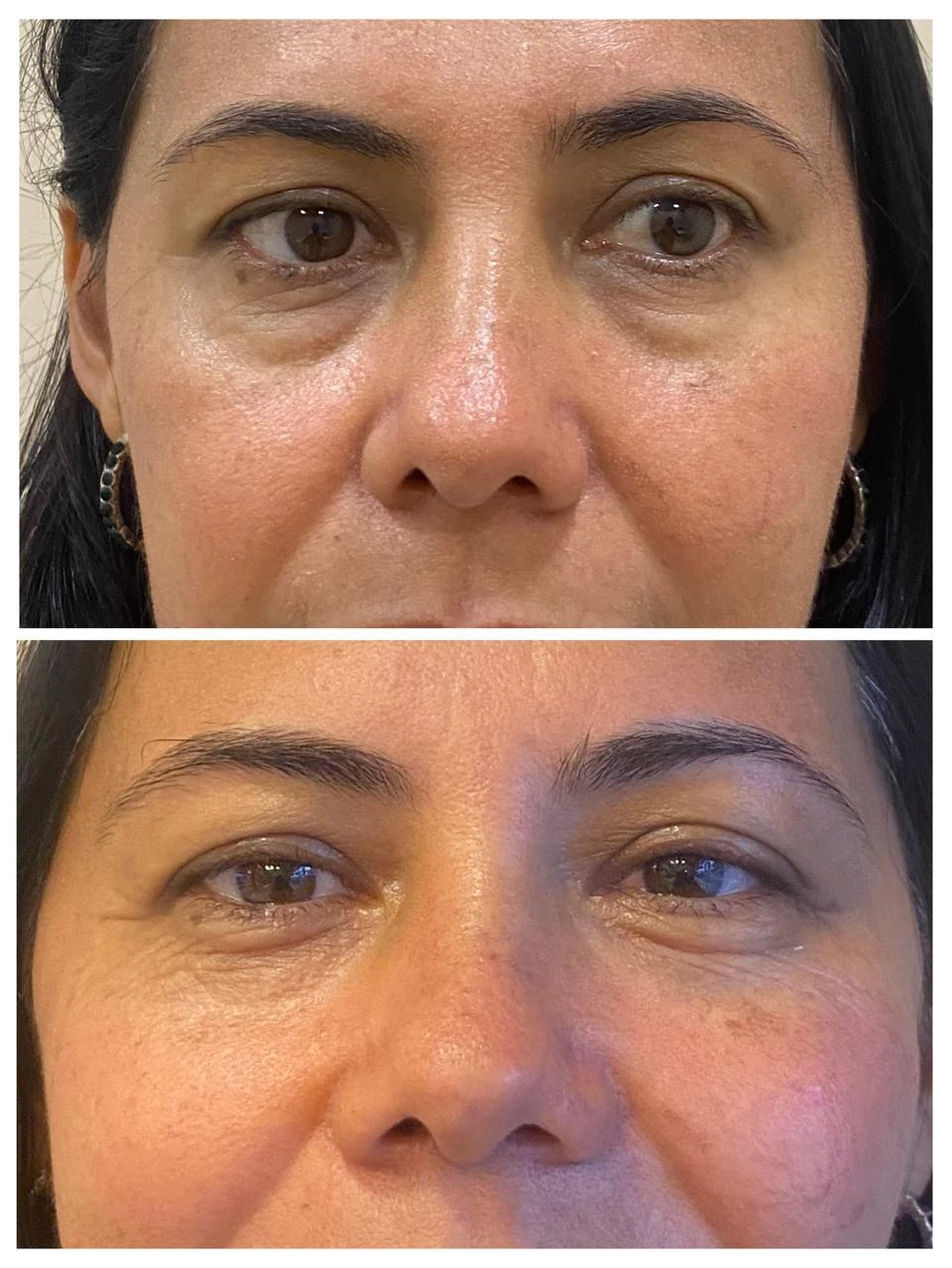 Resultado na região dos olhos — Dra. Tulipa Braga