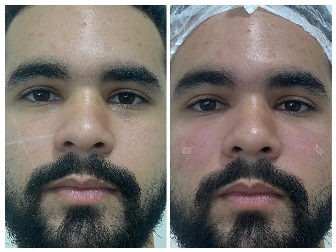Resultado em paciente masculino — Dra. Tulipa Braga