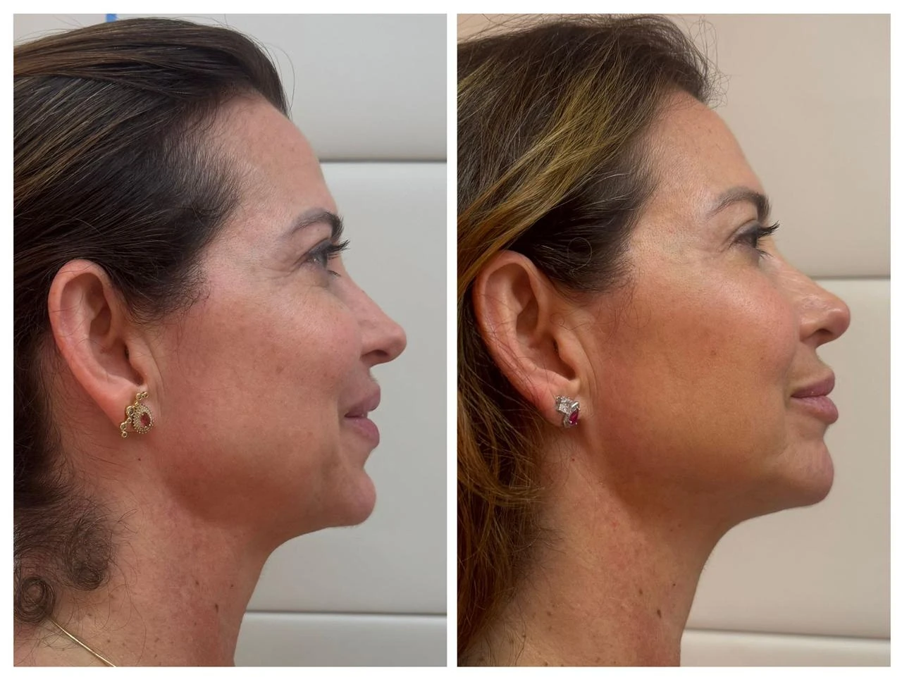 Resultado de perfil e contorno facial — Dra. Tulipa Braga