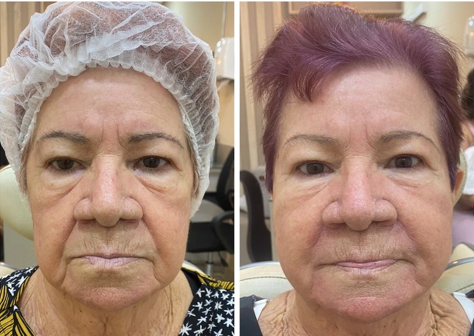 Antes e depois de fios de sustentação — Dra. Tulipa Braga